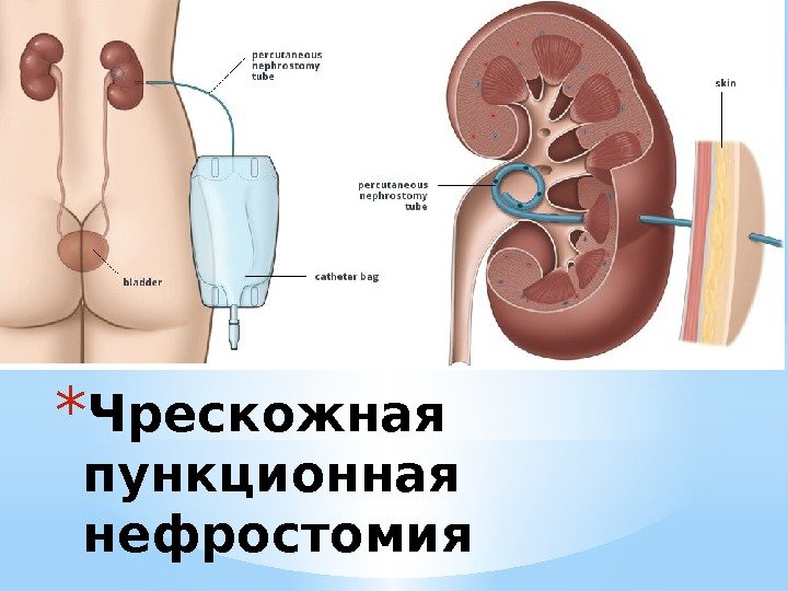 * Чрескожная пункционная нефростомия 