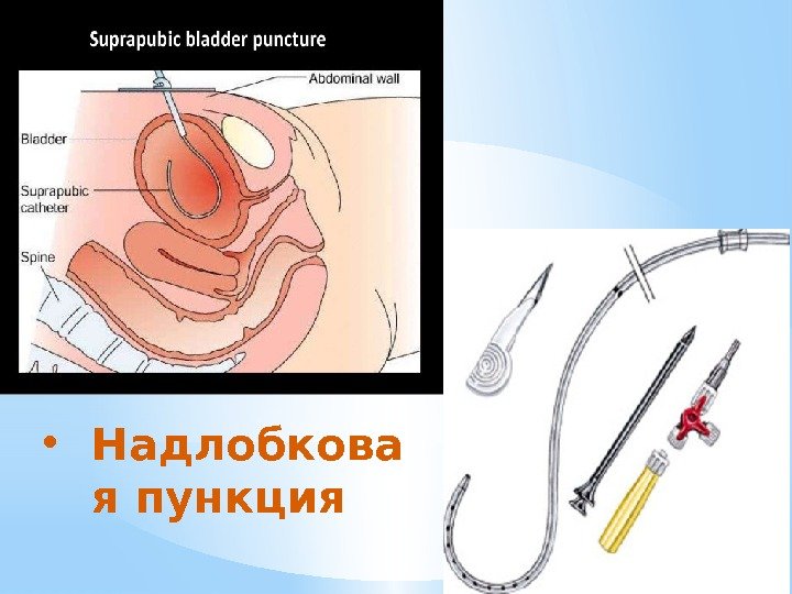  • Надлобкова я пункция 