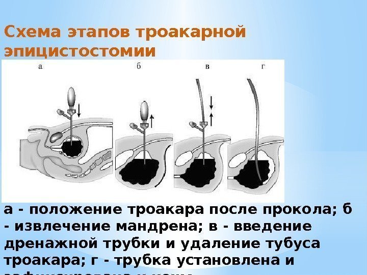 а - положение троакара после прокола; б - извлечение мандрена; в - введение дренажной