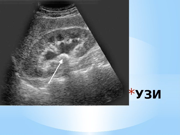 * УЗИ 