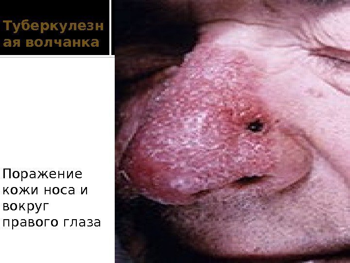 Туберкулезн ая волчанка Поражение кожи носа и вокруг правого глаза  
