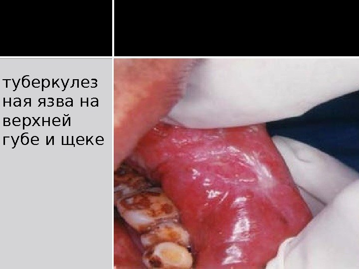 туберкулез ная язва на верхней губе и щеке 