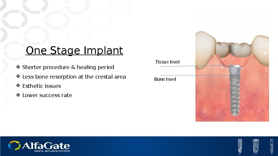 One Stage Implant Shorter procedure & healing period Less bone resorption at the crestal