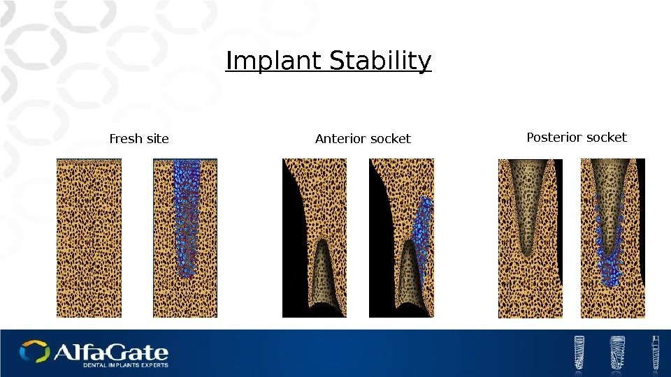 Implant Stability Fresh site Anterior socket Posterior socket 