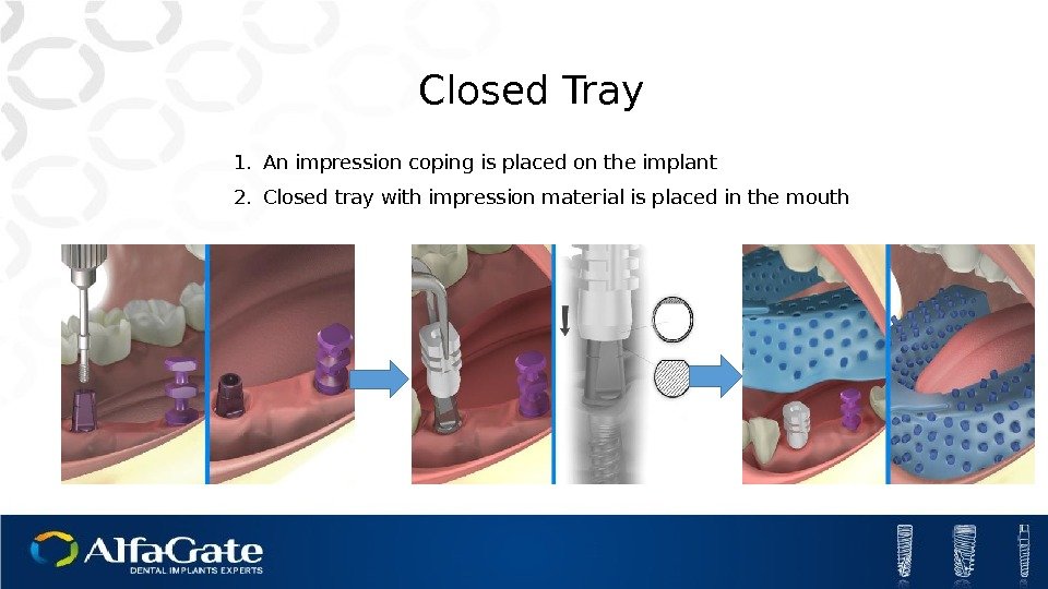 1. An impression coping is placed on the implant 2. Closed tray with impression