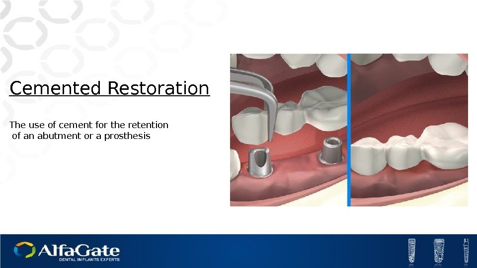 Cemented Restoration The use of cement for the retention  of an abutment or