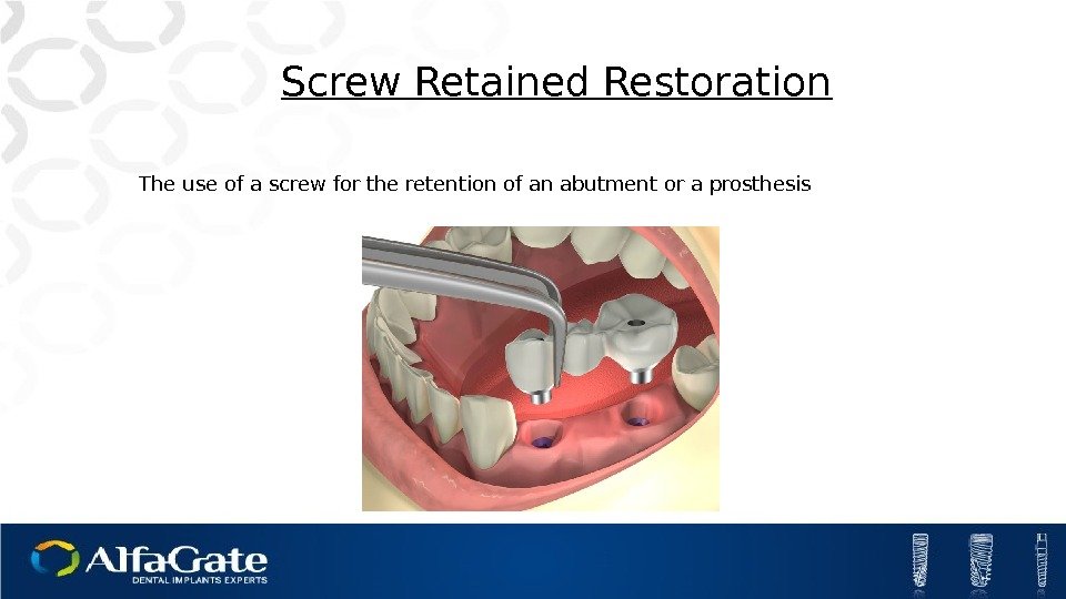 Screw Retained Restoration The use of a screw for the retention of an abutment