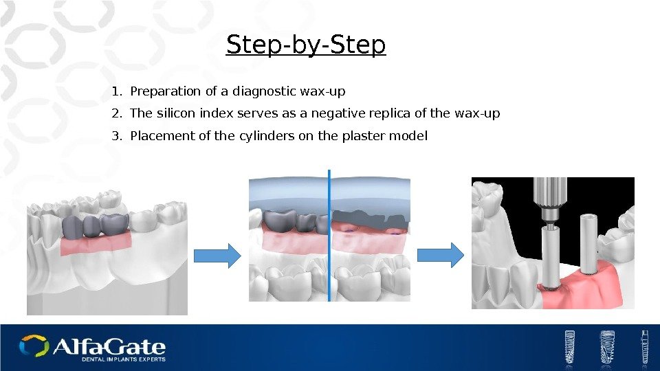 1. Preparation of a diagnostic wax-up 2. The silicon index serves as a negative