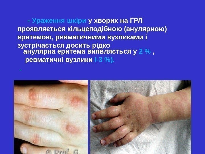  - У раження шкіри у хворих на ГРЛ  проявляється кільцеподібною (анулярною) еритемою,