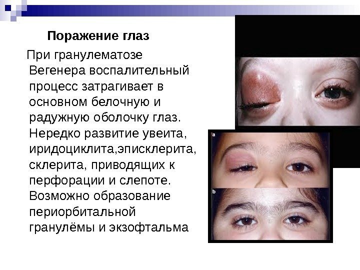    Поражение глаз При гранулематозе Вегенера воспалительный процесс затрагивает в основном белочную