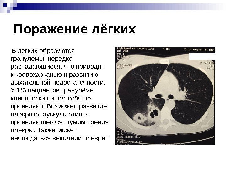 Поражение лёгких  В легких образуются гранулемы, нередко распадающиеся, что приводит к кровохарканью и