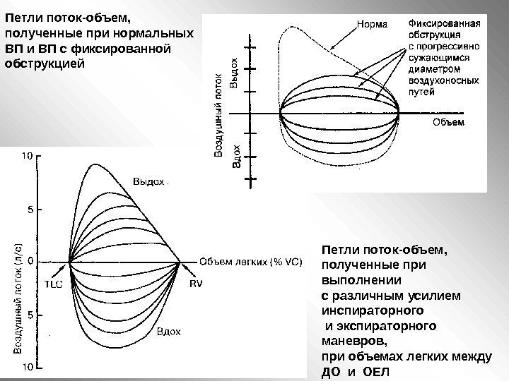   Петли поток-объем,  полученные при нормальных ВП и ВП с фиксированной обструкцией