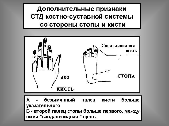   А - безымянный палец кисти больше указательного Б - второй палец стопы