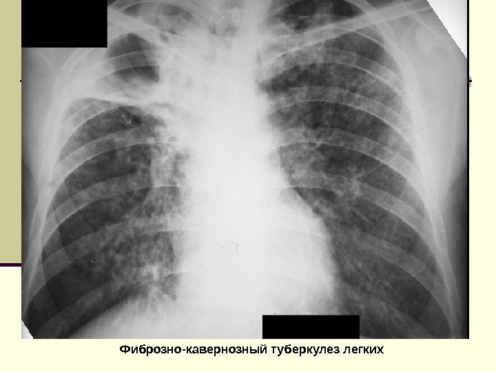   Фиброзно-кавернозный туберкулез легких 