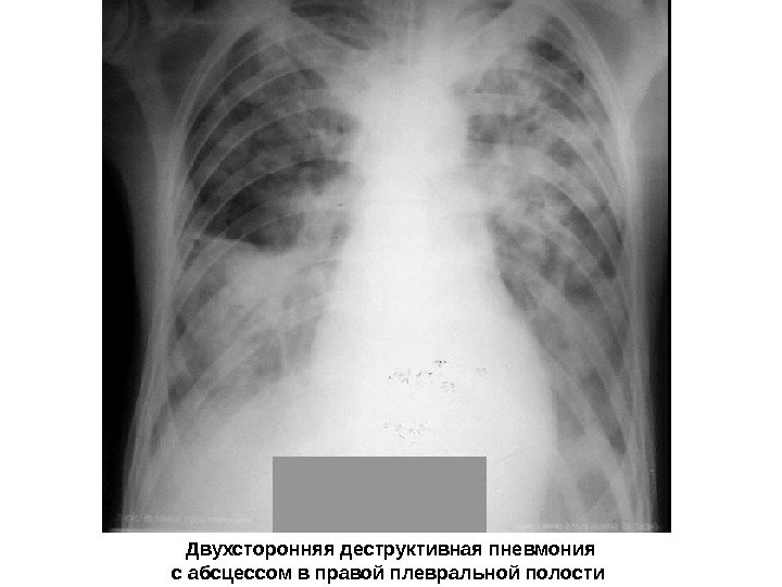   Двухсторонняя деструктивная пневмония с абсцессом в правой плевральной полости 