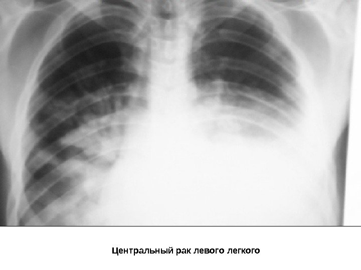   Центральный рак левого легкого 