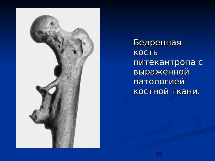 55 Бедренная кость питекантропа с выраженной патологией костной ткани. 