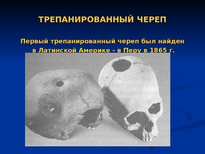 57 ТРЕПАНИРОВАННЫЙ ЧЕРЕП Первый трепанированный череп был найден  в Латинской Америке - в