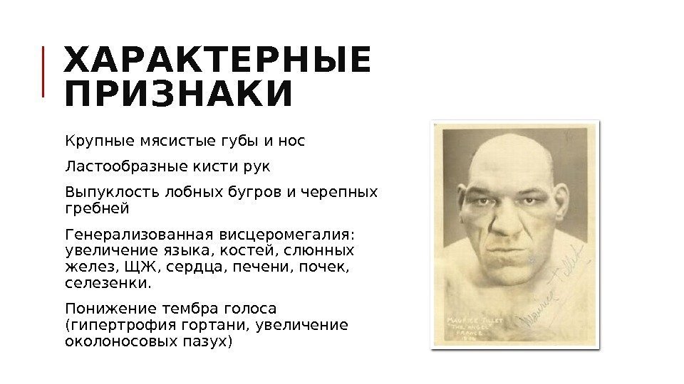 ХАРАКТЕРНЫЕ ПРИЗНАКИ  Крупные мясистые губы и нос  Ластообразные кисти рук  Выпуклость