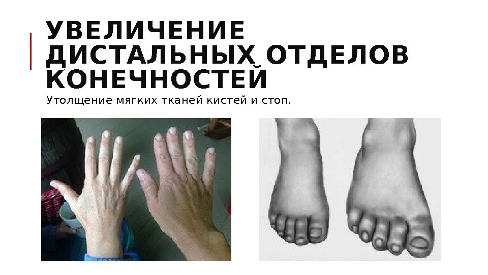 УВЕЛИЧЕНИЕ ДИСТАЛЬНЫХ ОТДЕЛОВ КОНЕЧНОСТЕЙ  Утолщение мягких тканей кистей и стоп. 