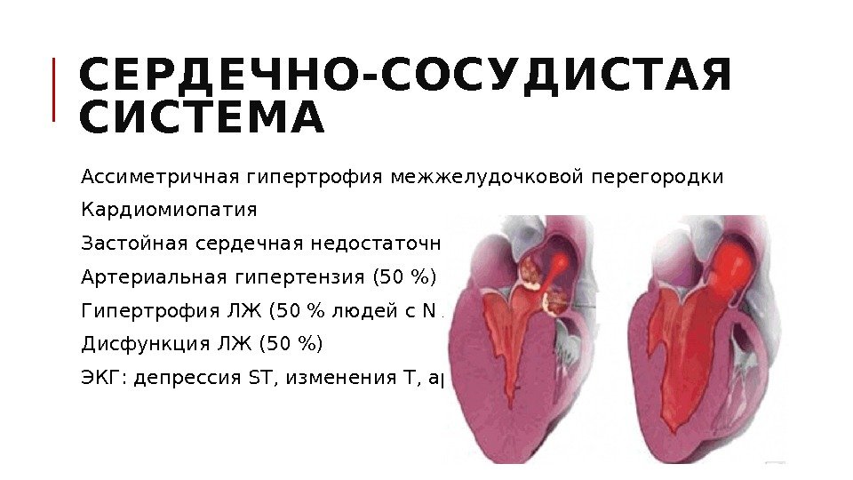 СЕРДЕЧНО-СОСУДИСТАЯ СИСТЕМА  Ассиметричная гипертрофия межжелудочковой перегородки  Кардиомиопатия  Застойная сердечная недостаточность 