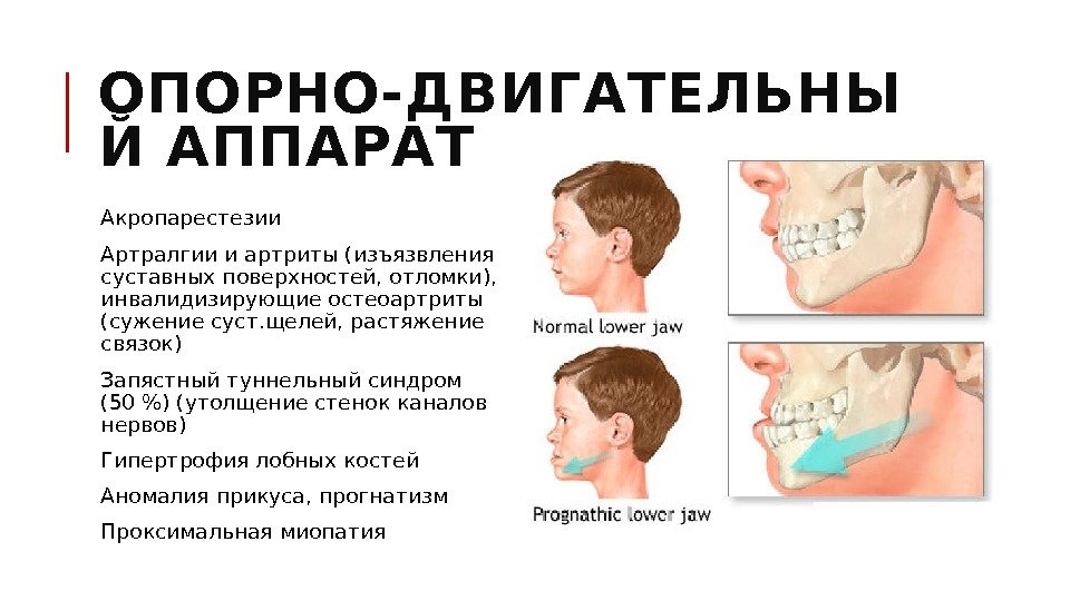 ОПОРНО-ДВИГАТЕЛЬНЫ Й АППАРАТ  Акропарестезии  Артралгии и артриты (изъязвления суставных поверхностей, отломки), 