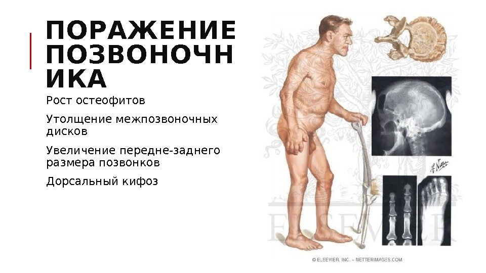 ПОРАЖЕНИЕ ПОЗВОНОЧН ИКА  Рост остеофитов  Утолщение межпозвоночных дисков  Увеличение передне-заднего размера