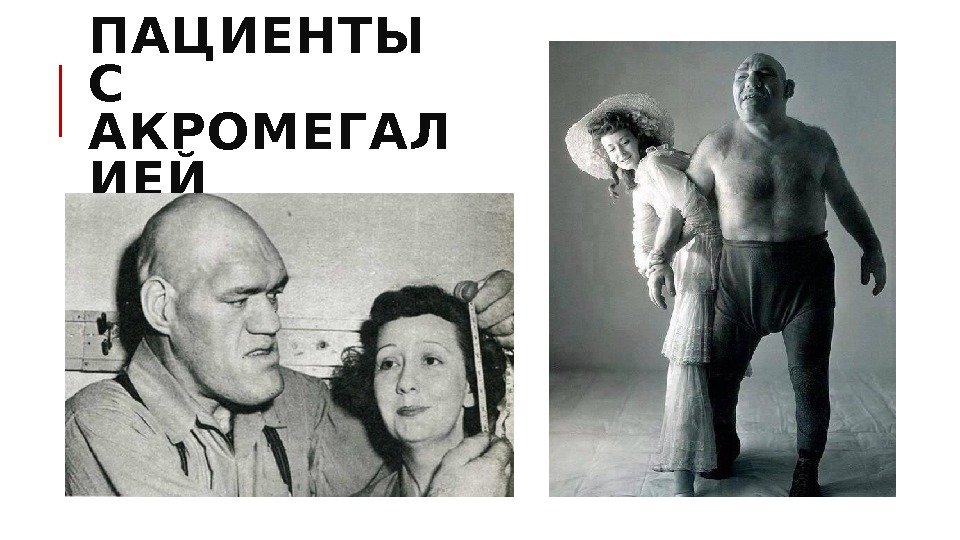 ПАЦИЕНТЫ С АКРОМЕГАЛ ИЕЙ 