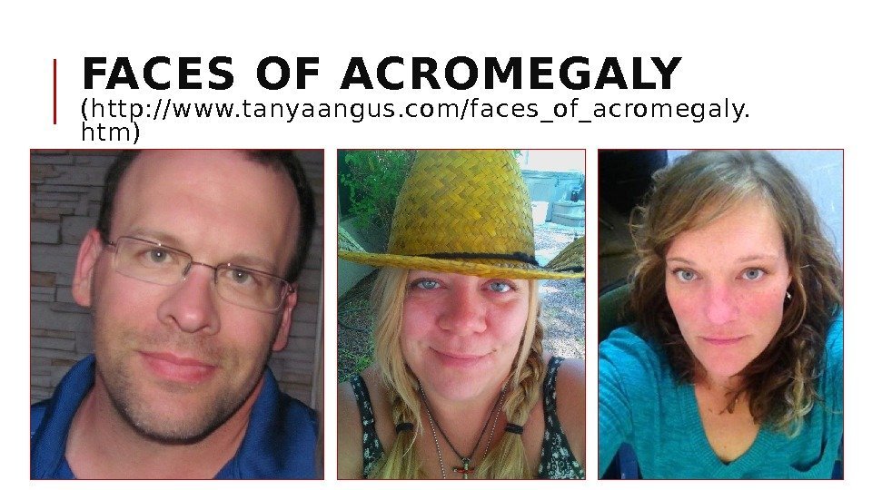 FACES OF ACROMEGALY (http: //www. tanyaangus. com/faces_of_acromegaly. htm) 