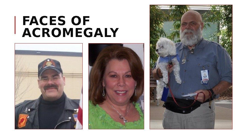 FACES OF ACROMEGALY 