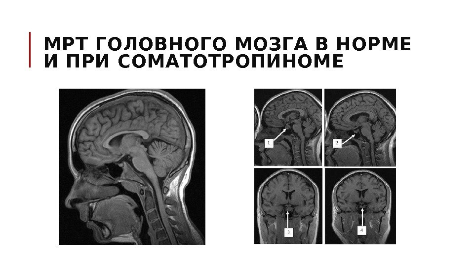 МРТ ГОЛОВНОГО МОЗГА В НОРМЕ И ПРИ СОМАТОТРОПИНОМЕ 