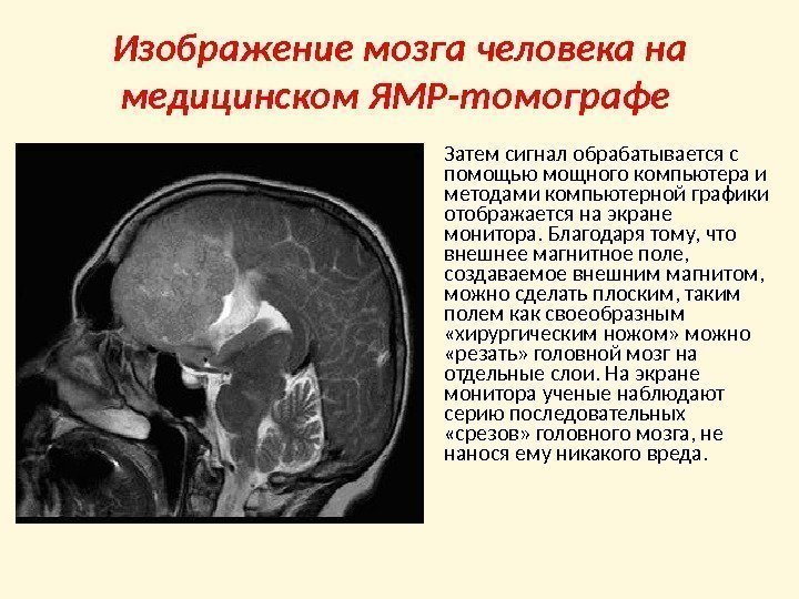 Изображение мозга человека на медицинском ЯМР-томографе  • Затем сигнал обрабатывается с помощью мощного