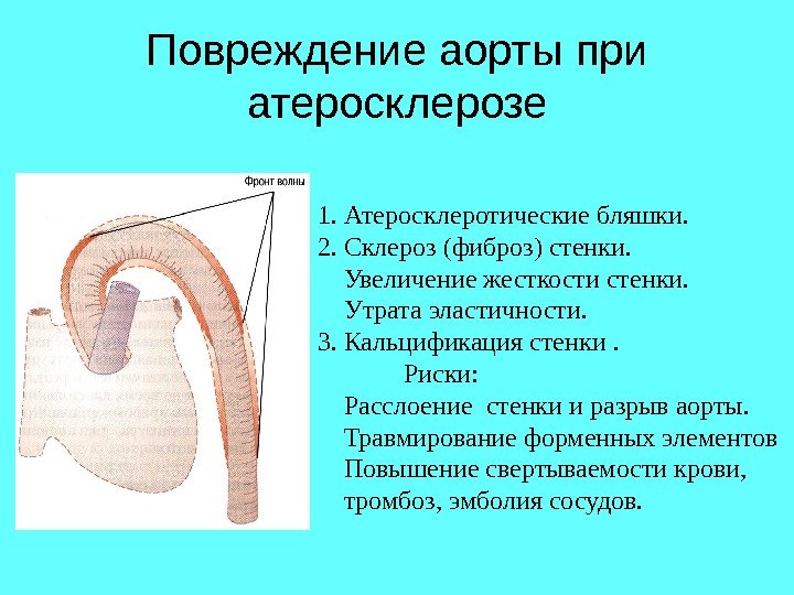 Повреждение аорты при атеросклерозе 1. Атеросклеротические бляшки. 2. Склероз (фиброз) стенки.  Увеличение жесткости