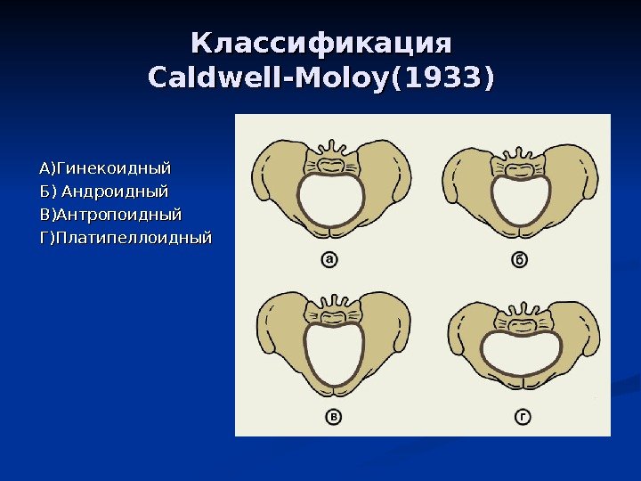 Классификация Caldwell-Moloy(1933) А)Гинекоидный Б) Андроидный В)Антропоидный Г)Платипеллоидный 