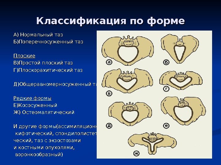 Классификация по форме А) Нормальный таз Б)Поперечносуженный таз Плоские В)Простой плоский таз Г)Плоскорахитический таз