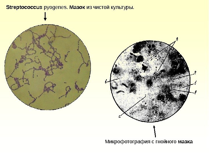 Streptococcus pyogenes.  Мазок из чистой культуры.  Микрофотография с гнойного мазка  
