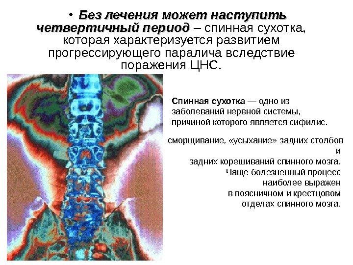   • Без лечения может наступить четвертичный период – спинная сухотка,  которая