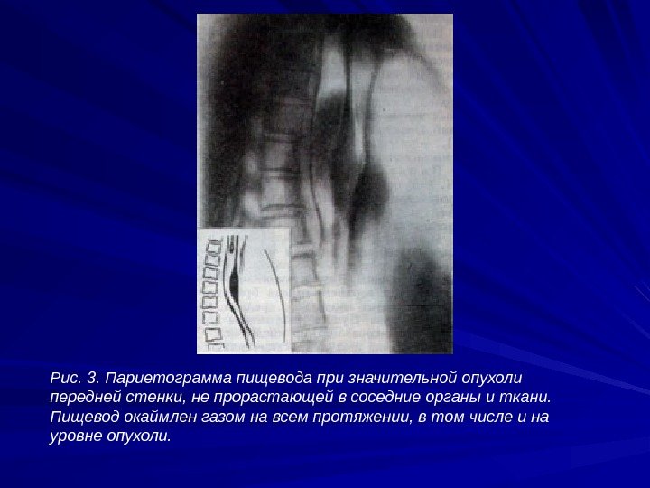 Рис. 3. Париетограмма пищевода при значительной опухоли передней стенки, не прорастающей в соседние органы
