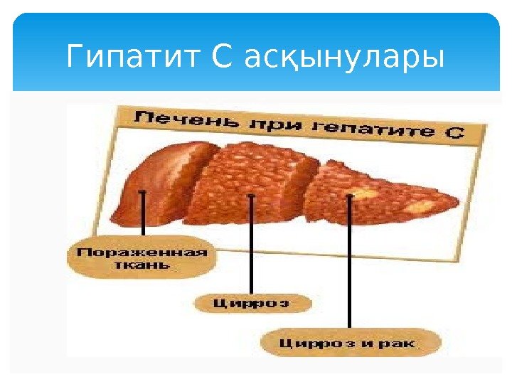 Бауыр циррозы презентация