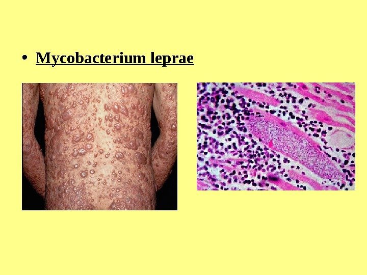  • Mycobacterium leprae 