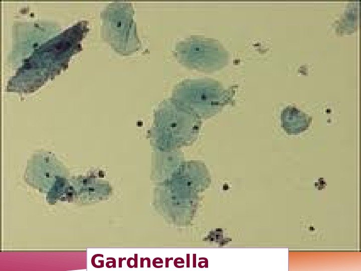 Gardnerella vaginalis 