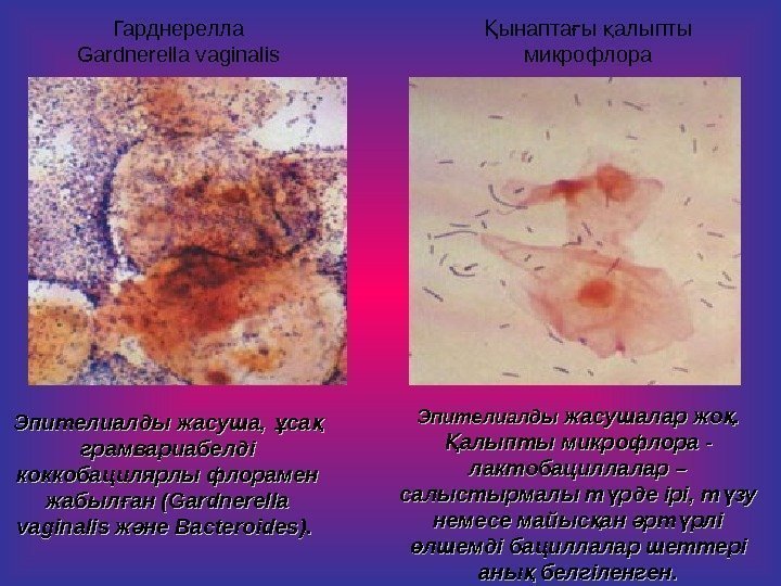   Гарднерелла Gardnerella vaginalis Эпителиалды жасуша,  са ұ қ грамвариабелді коккобацилярлы флорамен