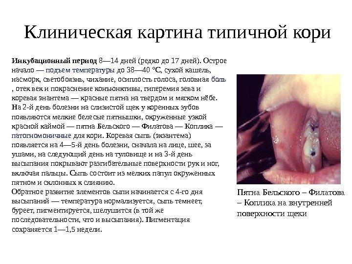 Клиническая картина типичной кори Пятна Бельского – Филатова – Коплика на внутренней поверхности щеки.