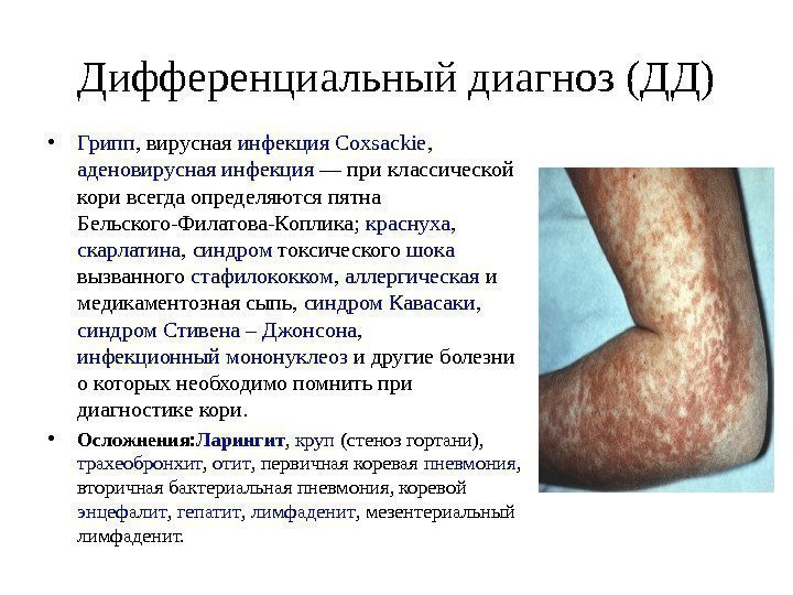 Дифференциальный диагноз (ДД) • Грипп , вирусная инфекция  Coxsackie ,  аденовирусная инфекция