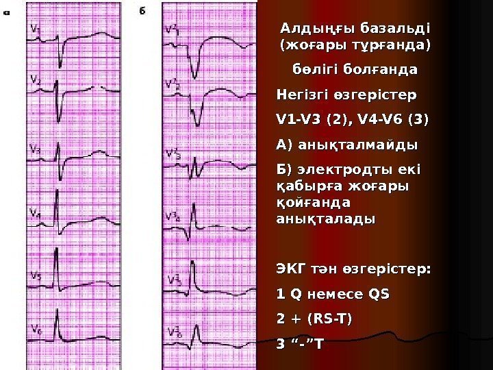 Стенки экг в отведениях