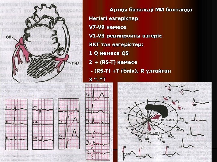 Артқы базальді МИ болғанда Негізгі өзгерістер  V 7 -V 9 немесе  V