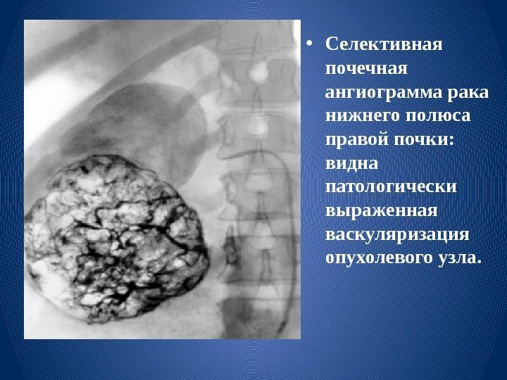  • Селективная почечная ангиограмма рака нижнего полюса правой почки:  видна патологически выраженная