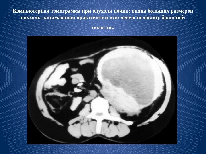Компьютерная томограмма при опухоли почки: видна больших размеров опухоль, занимающая практически всю левую половину