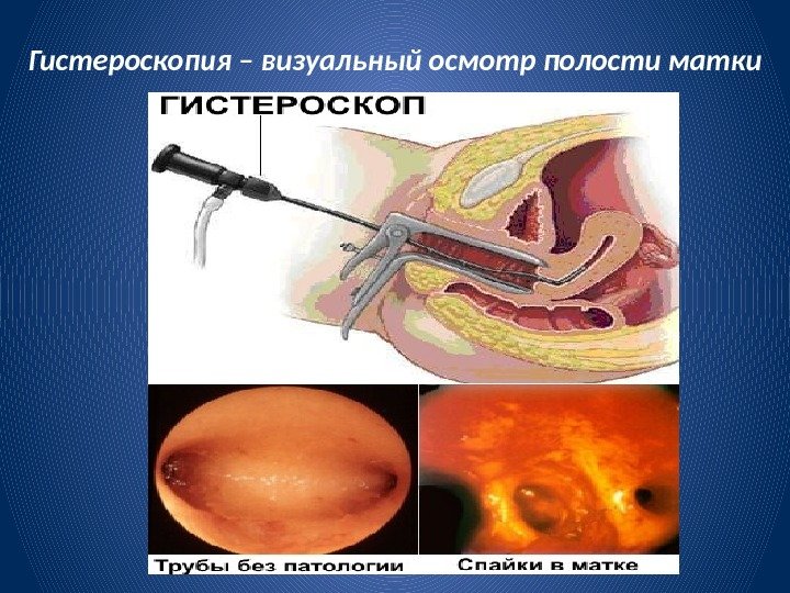 Гистероскопия – визуальный осмотр полости матки 
