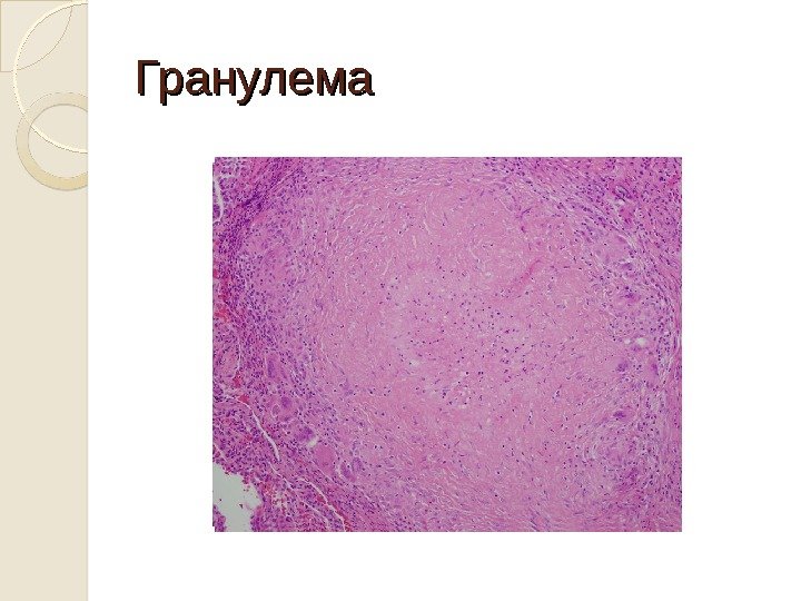 Гранулема 